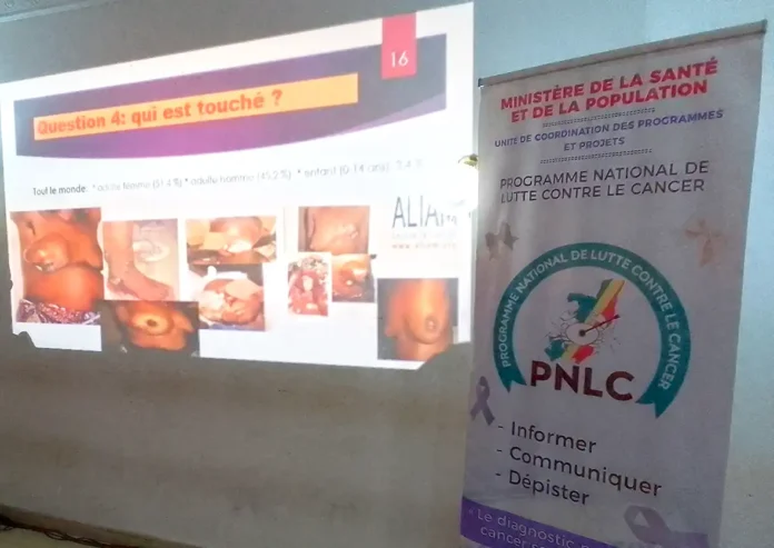 Une vue des cancers du sein